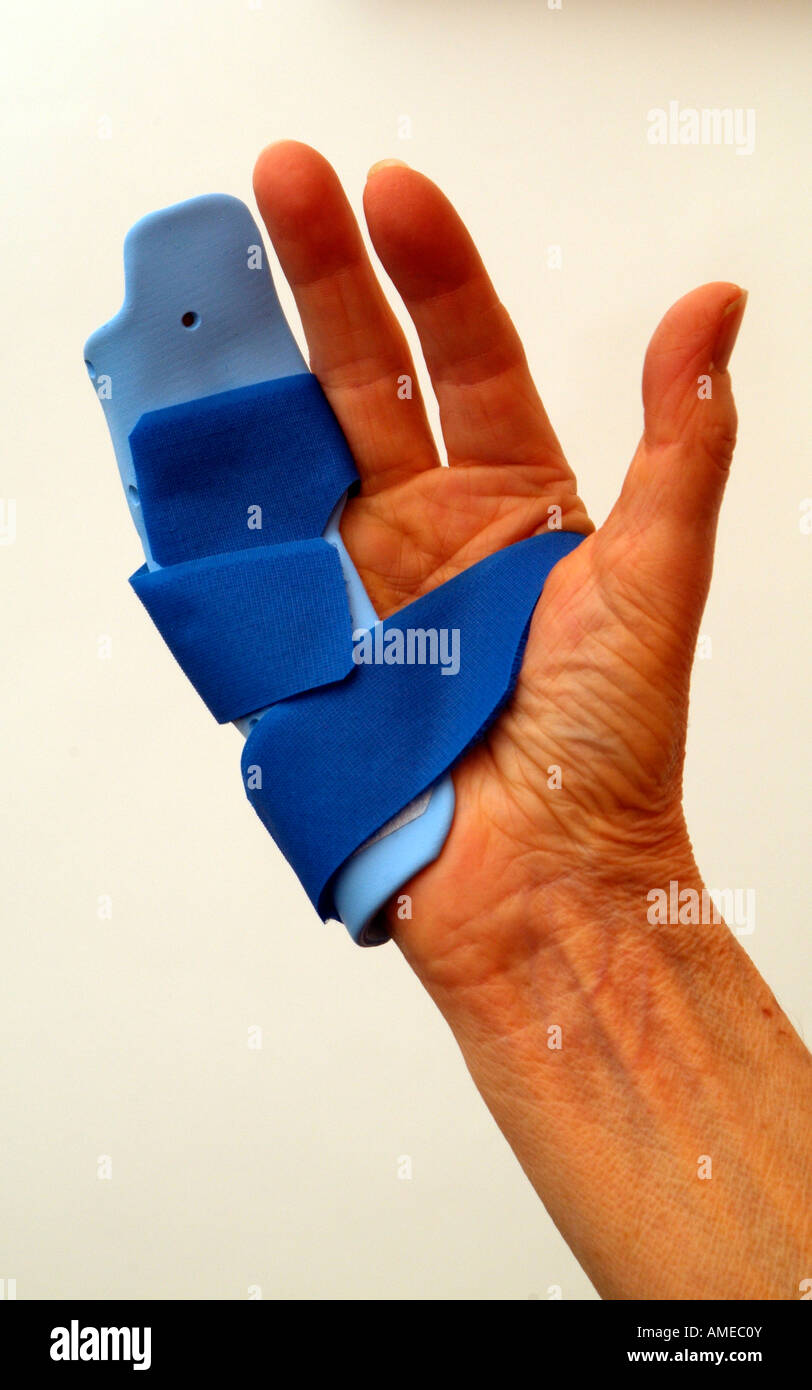 Dupuytrens Contracture Clinical Night Splint Fitting to Fingers and