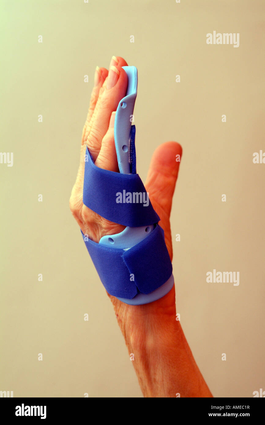 Dupuytrens contracture Clinical Night Splint Fitting to Fingers and