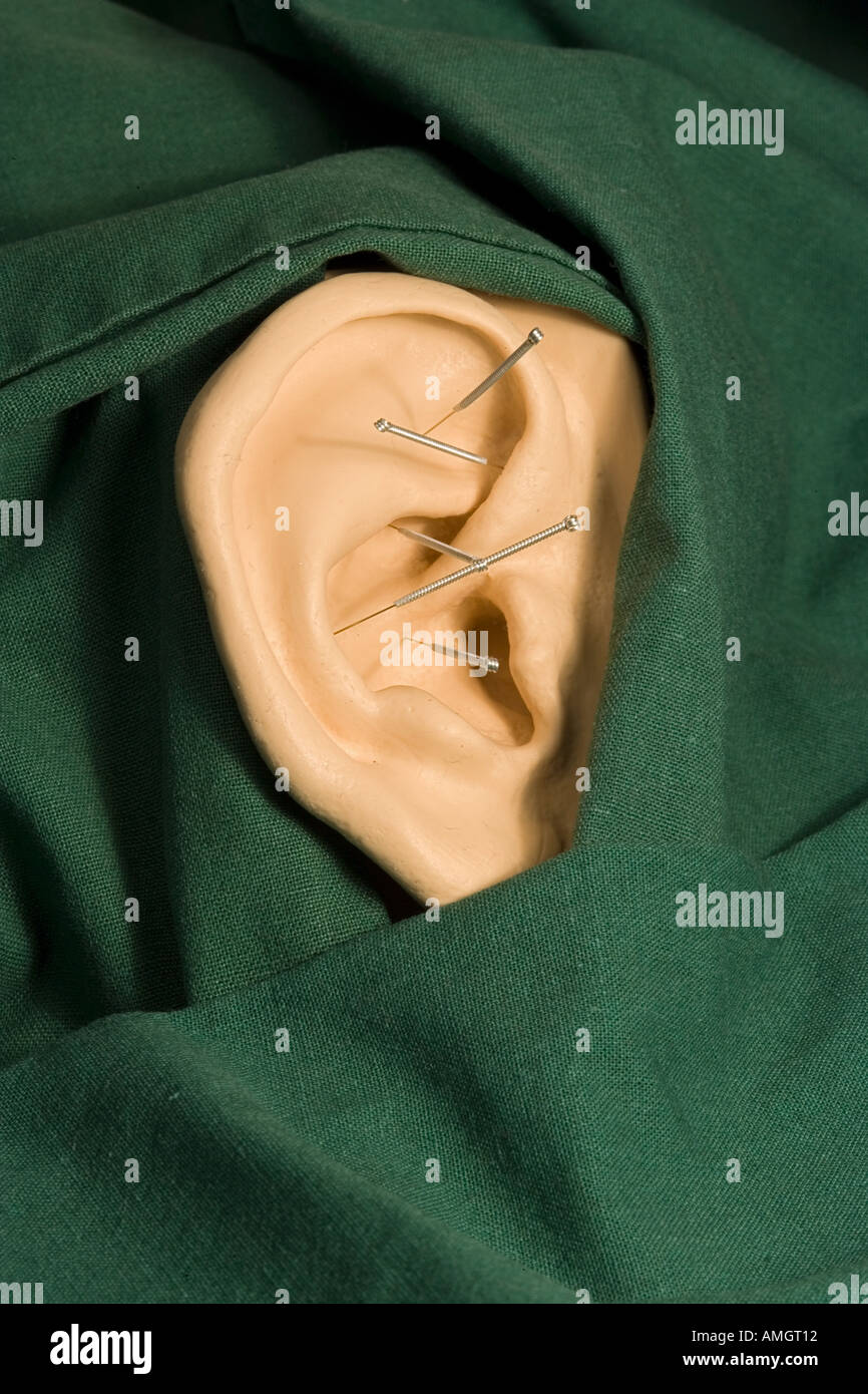 Nada acupuncture hires stock photography and images Alamy
