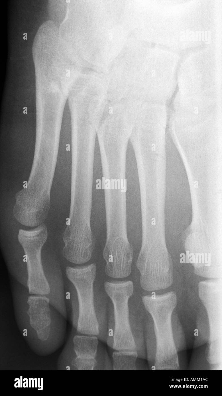 X ray transverse fracture of 5th distal phalanx Stock Photo