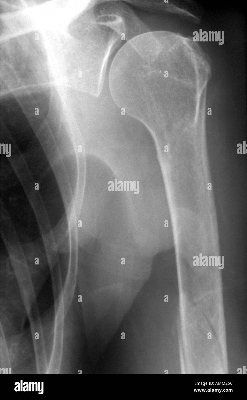 Shoulder x ray spiral fracture of humerus Stock Photo Alamy