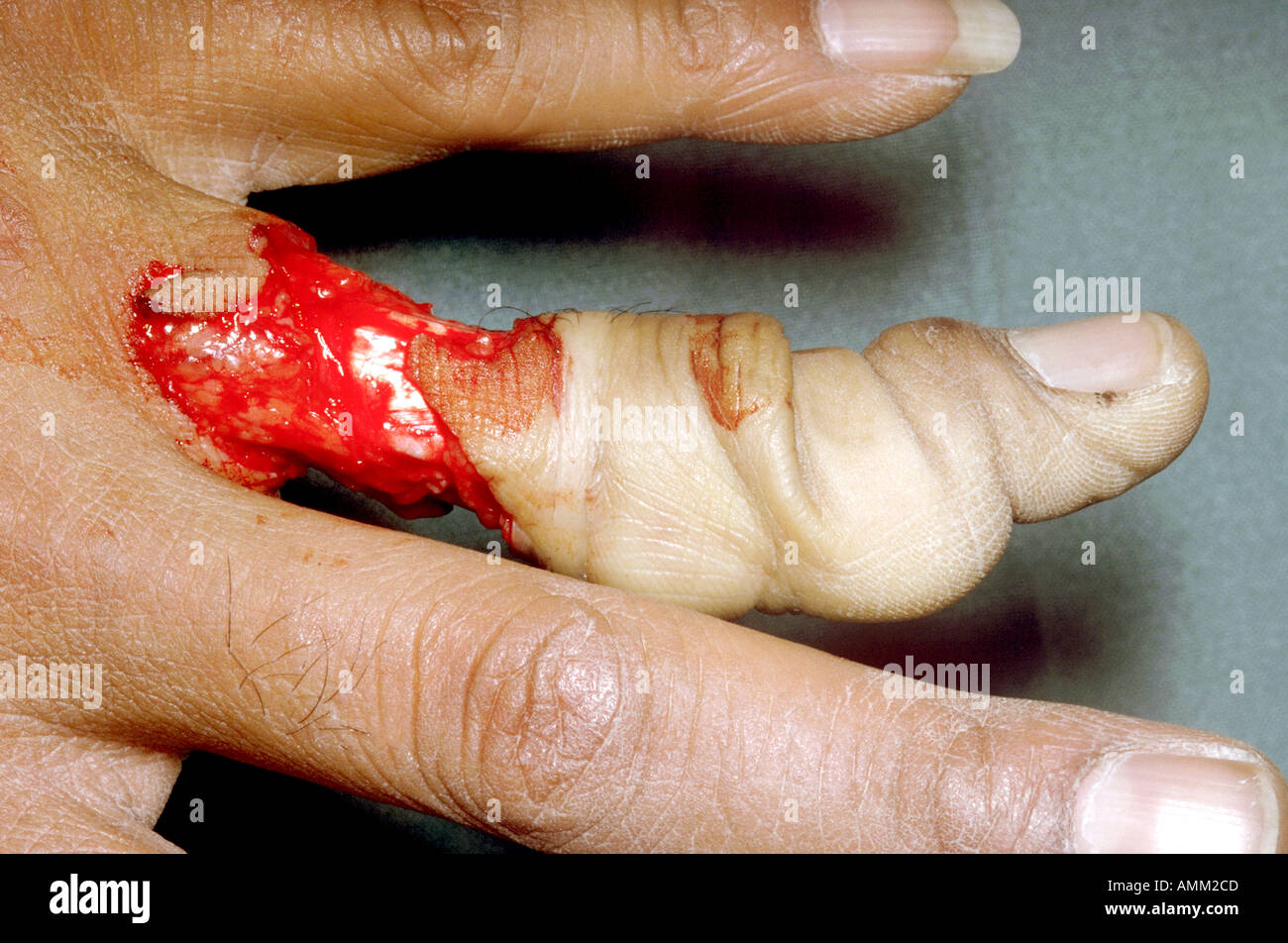 Ring finger injury hi-res stock photography and images - Alamy