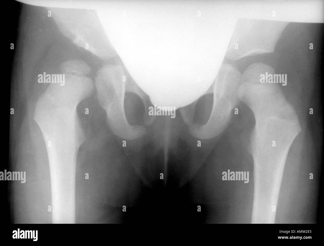 X ray congenital dislocation of hips Stock Photo