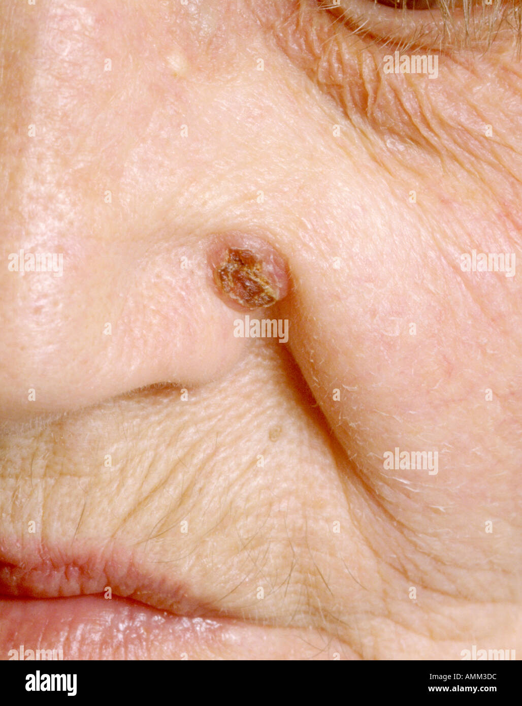 Basal cell carcinoma BCC on cheek Stock Photo Alamy