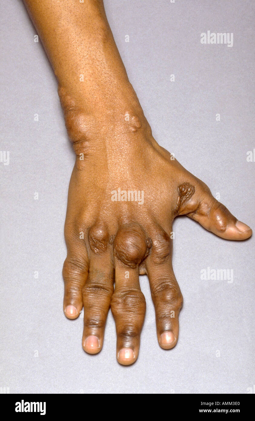 Raised cholesterol tuberous xanthoma Stock Photo - Alamy, image size:842x1390