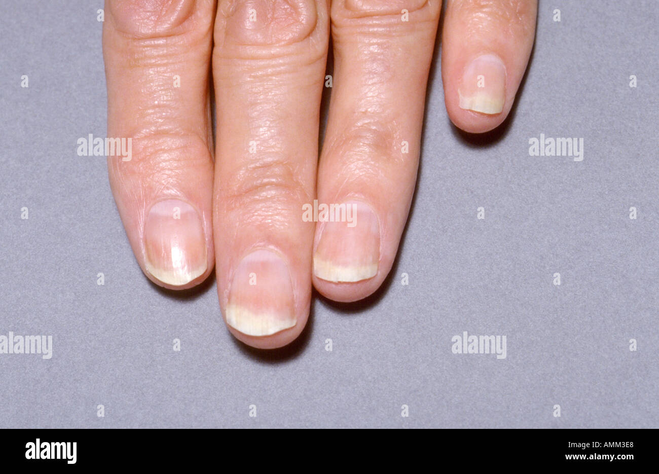 Chronic fungal infection fingernails Stock Photo