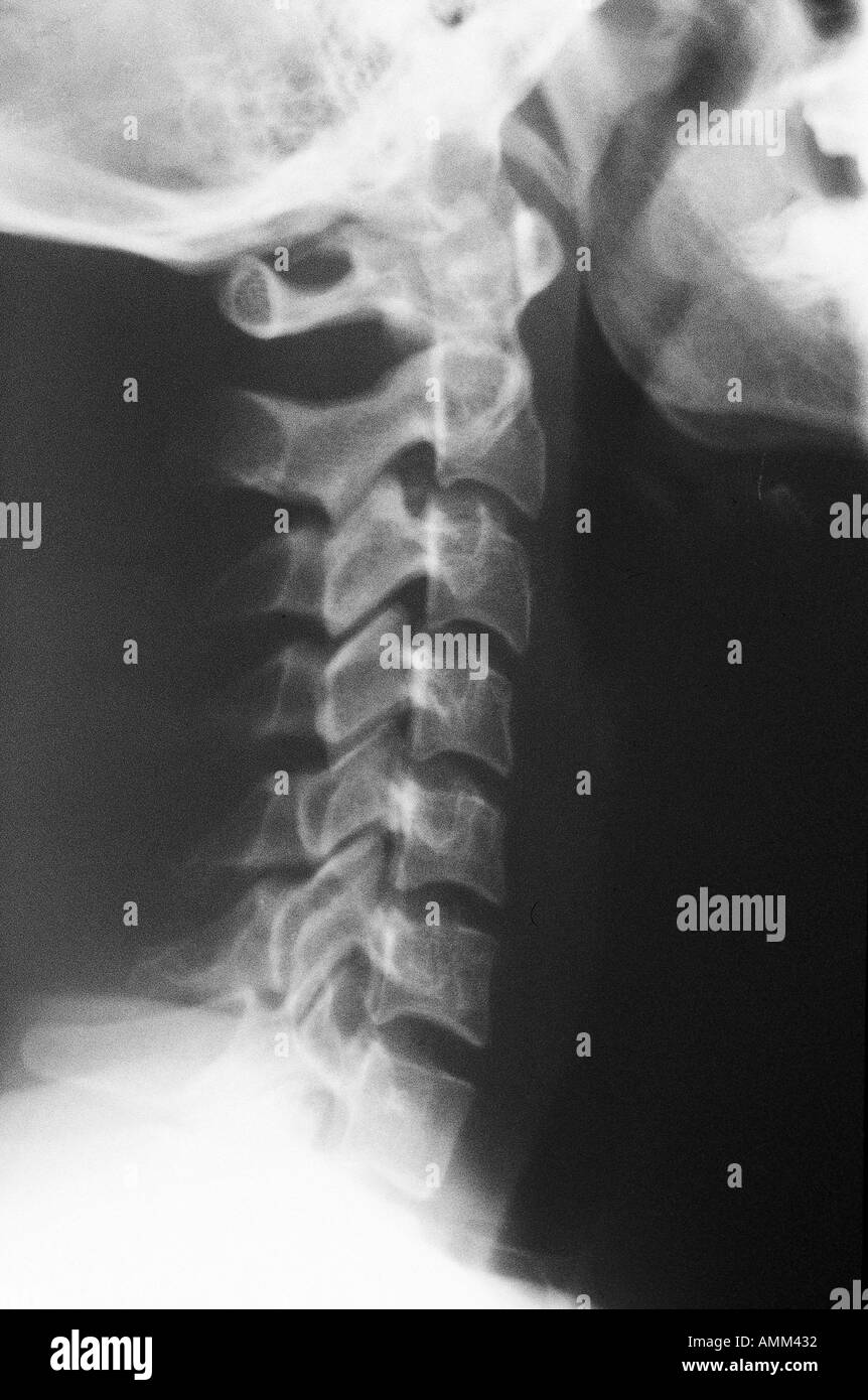 Cervical Spine X Ray Anatomy