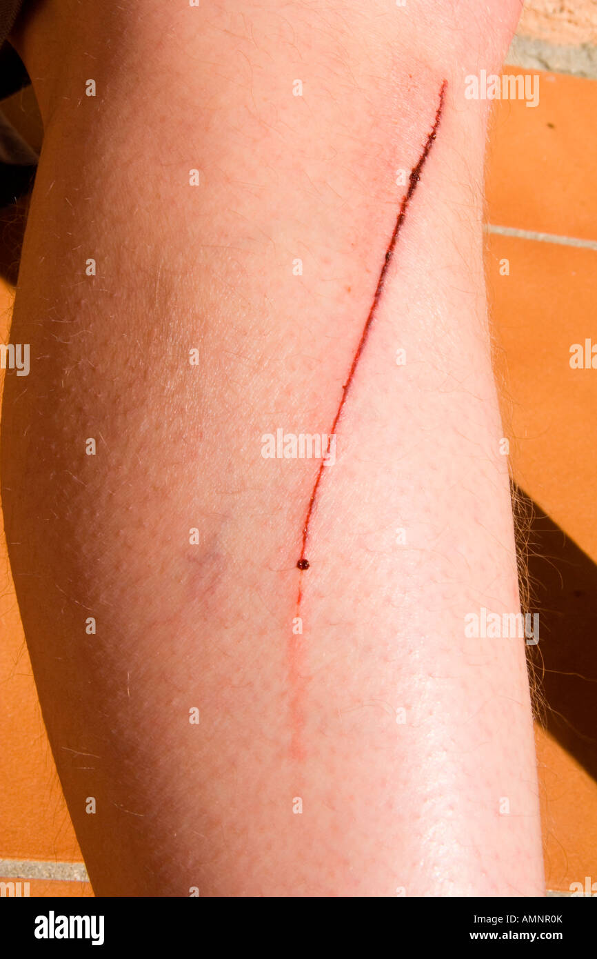 Scatched leg wound, fresh gash showing blood. Stock Photo