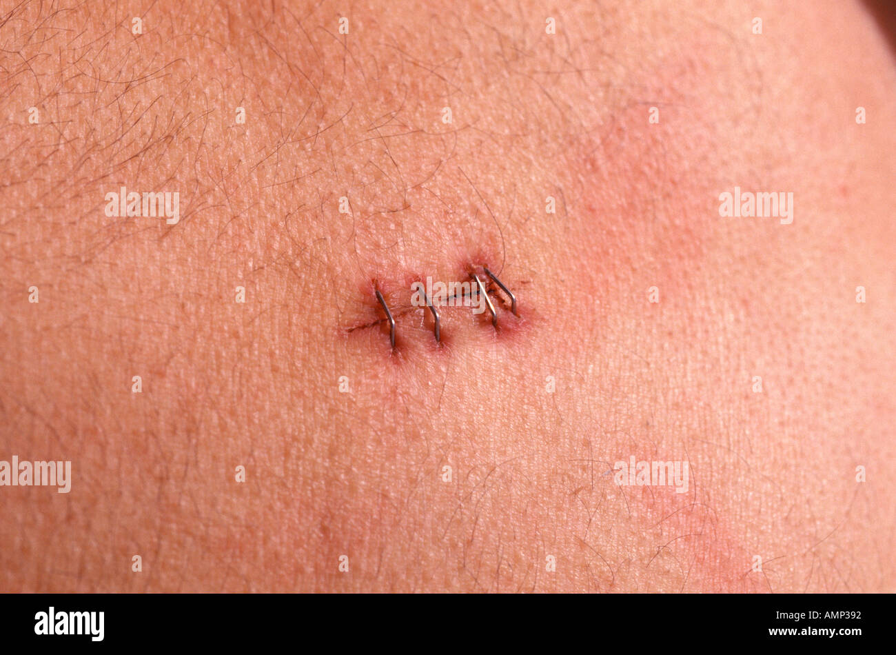 Stapled wound Stock Photo Alamy