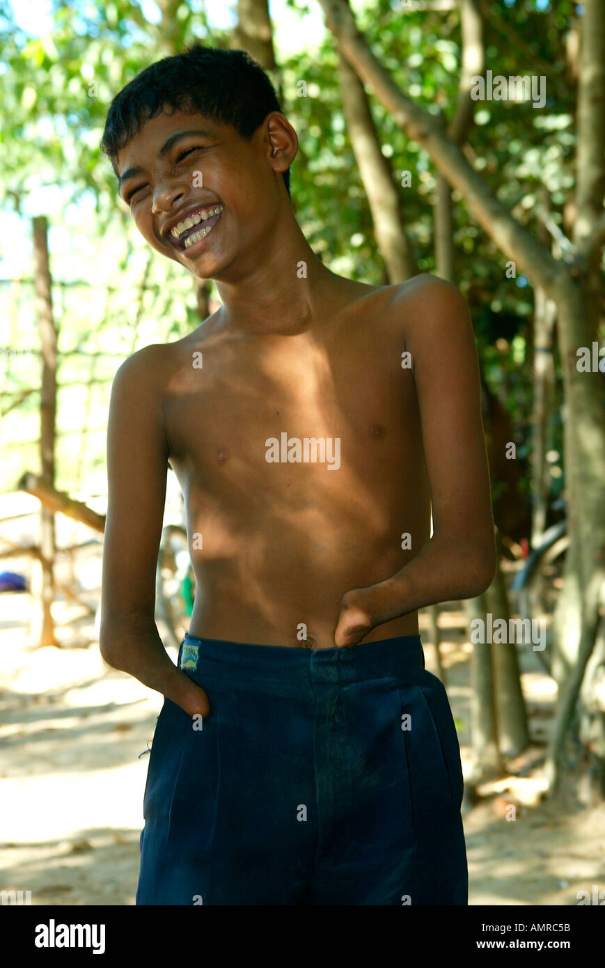 Landmine blast victim aged 12 laughing although he has lost his hands ...