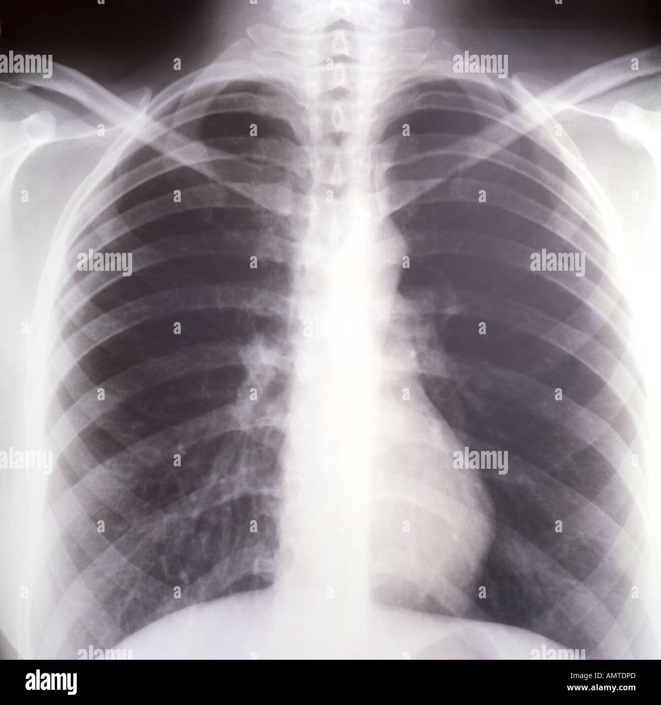 Chest radiograph hi-res stock photography and images - Alamy