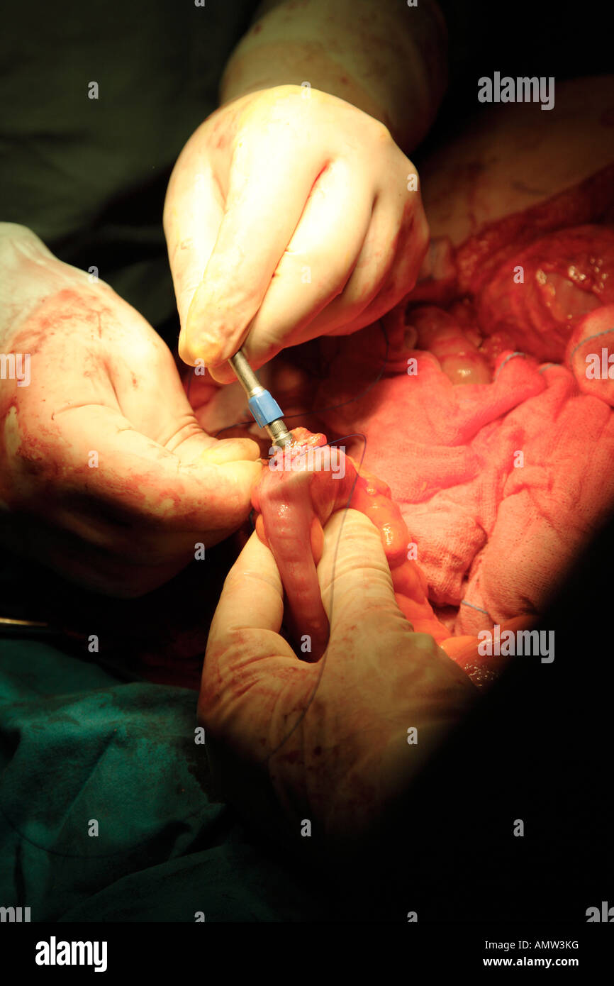 Closing stapler and stitching intestine during operation to remove bowel cancer Stock Photo