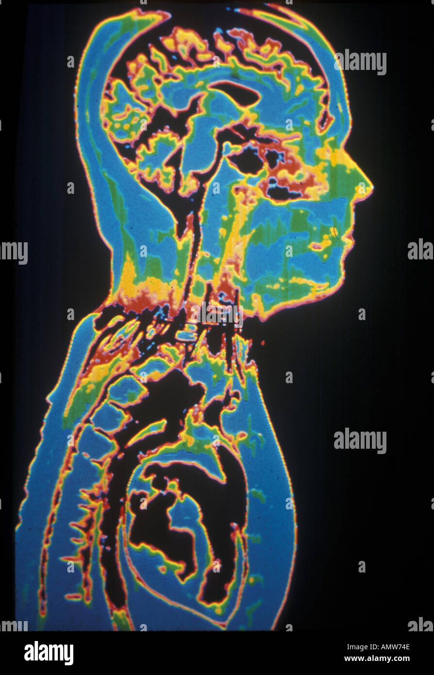 Brain Scan MRI Stock Photo - Alamy