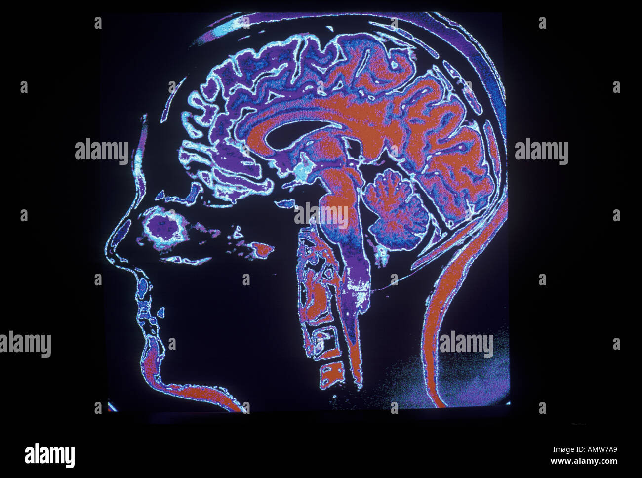 Brain Scan MRI Stock Photo - Alamy