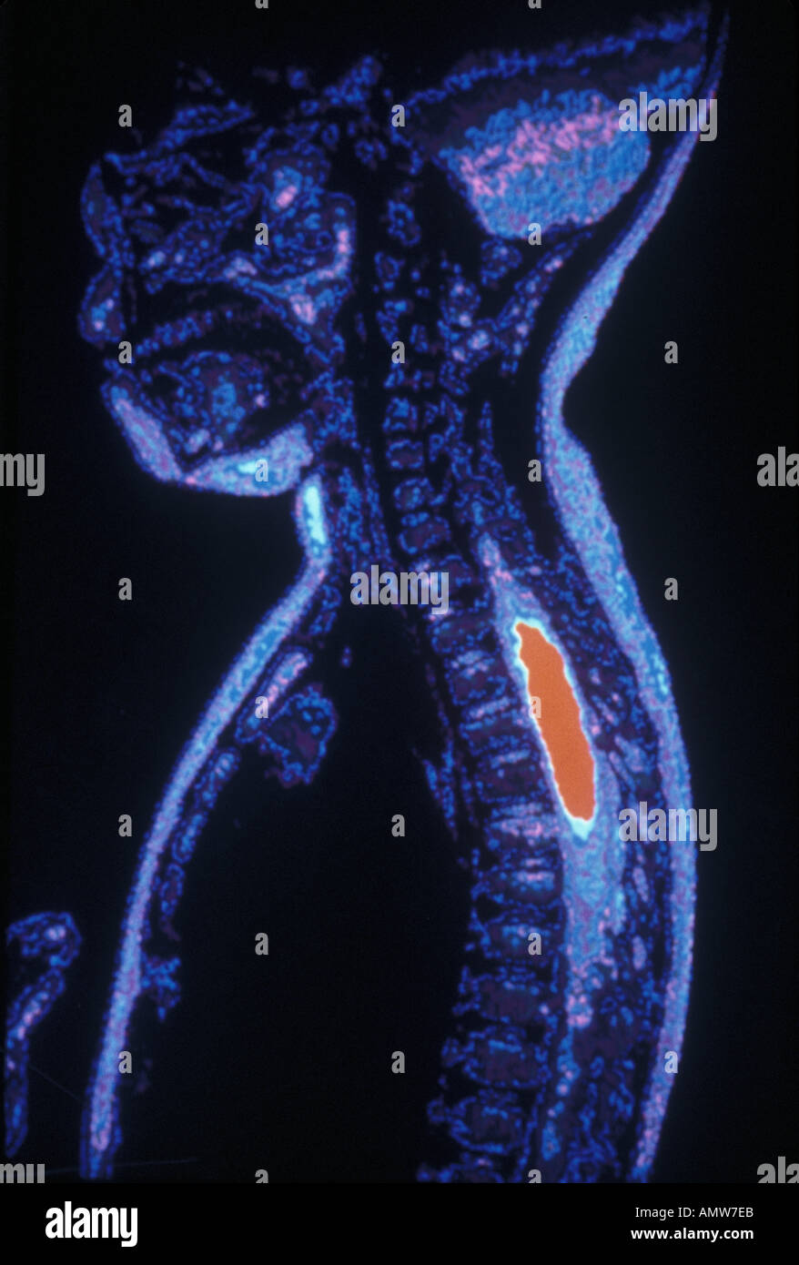 MRI Spinal tumor red Stock Photo - Alamy