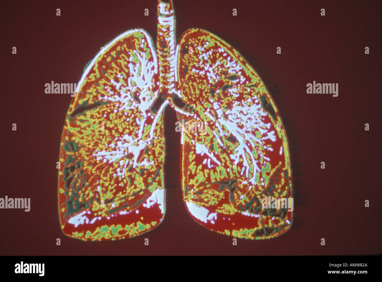 Normal lungs x ray hires stock photography and images Alamy