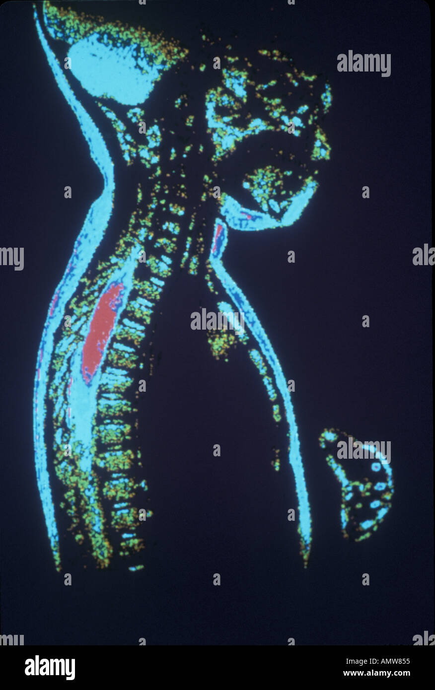 Mri of spinal cord hi-res stock photography and images - Alamy