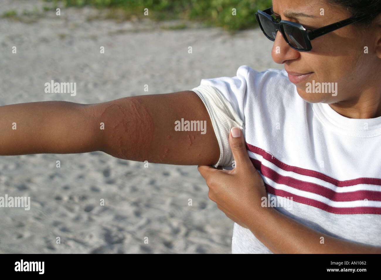 Florida, FL, South, Miami Beach, SoBe, adult adults woman women female lady, shows arm stung by jellyfish, marine life, sightseeing visitors travel tr Stock Photo