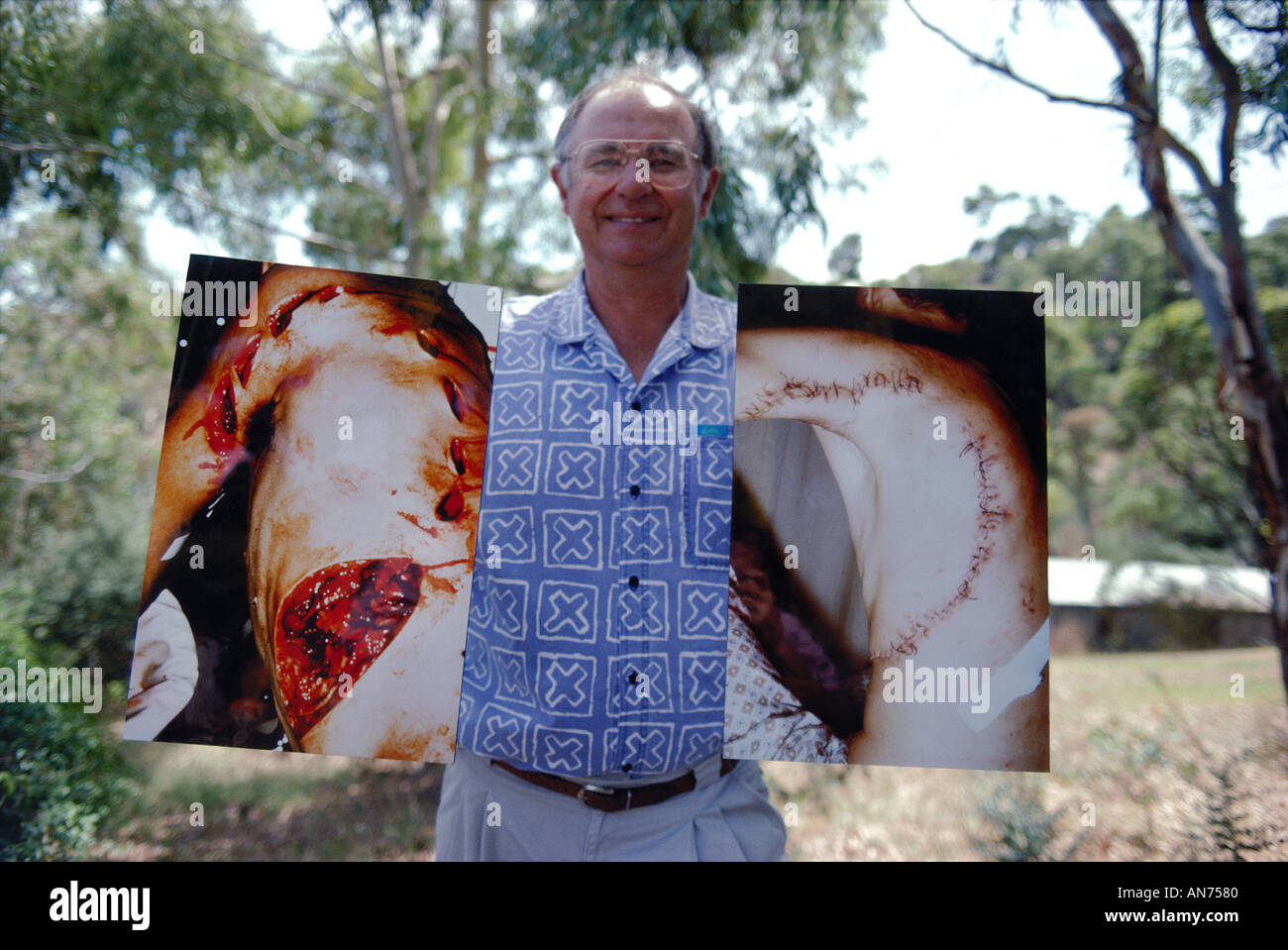 Rodney Fox a Great White Shark victim holds pictures of the bite marks before and after surgery in South Australia Stock Photo