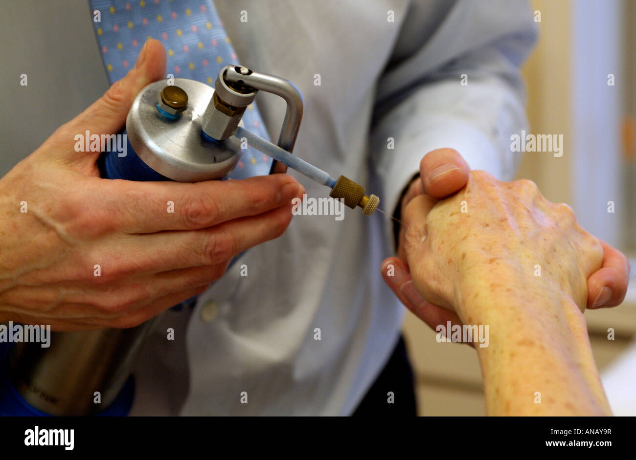 Dermatology nitrogen hires stock photography and images Alamy