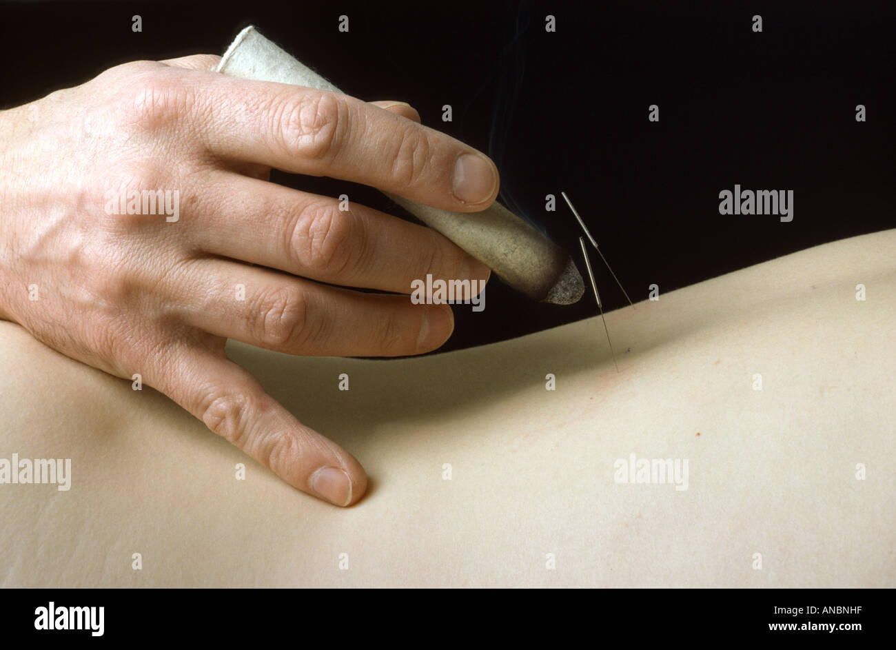 moxibustion stimulating the nervous system with heat on the body Stock Photo