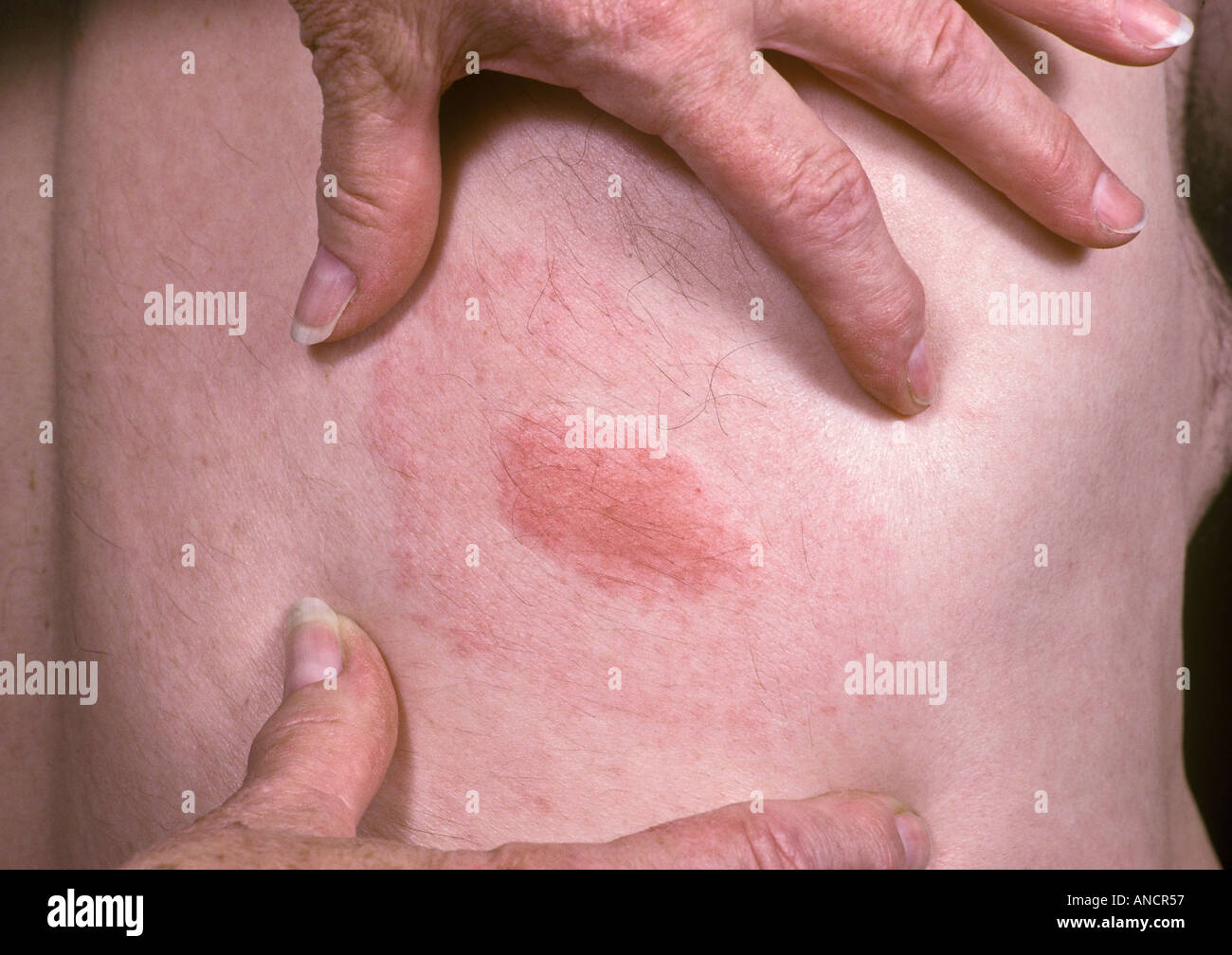 Target Rash from Deer Tick Bite Transmitting Lymes Disease Stock Photo