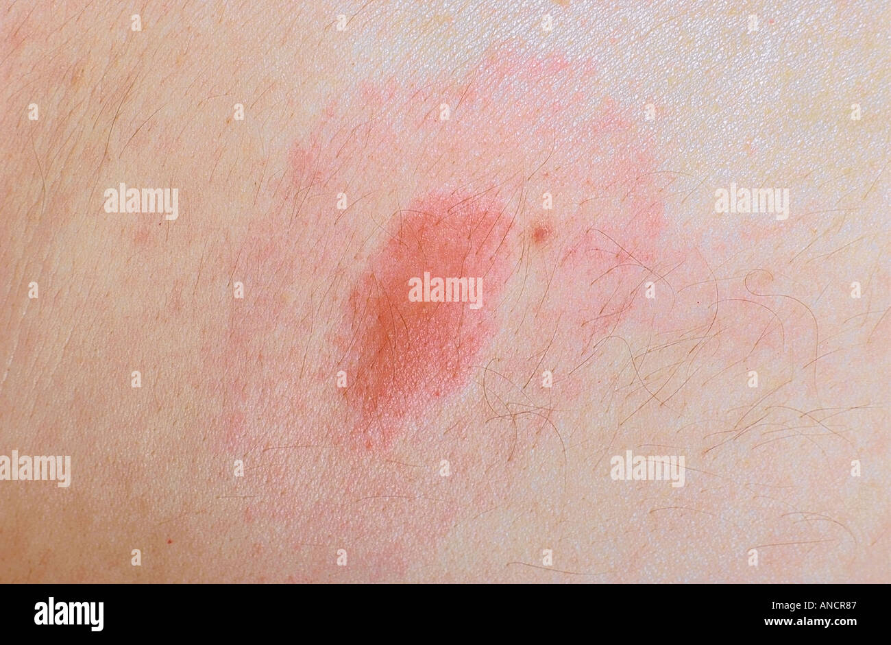 Target Rash from Deer Tick Bite Transmitting Lyme s Disease Stock Photo