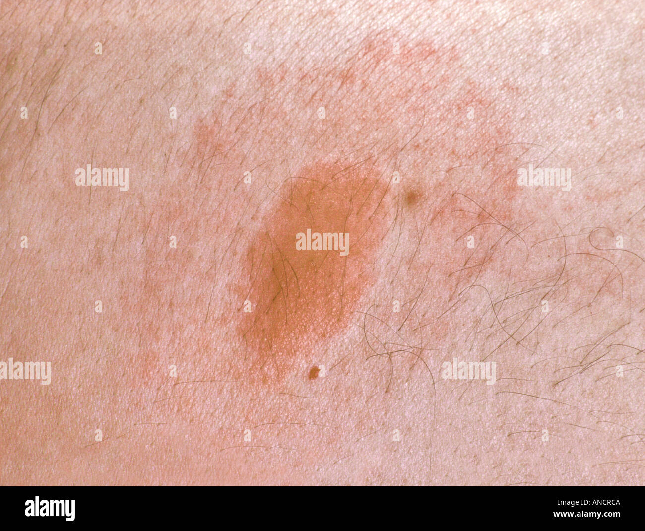 Target Rash from Deer Tick Bite Transmitting Lymes Disease Stock Photo