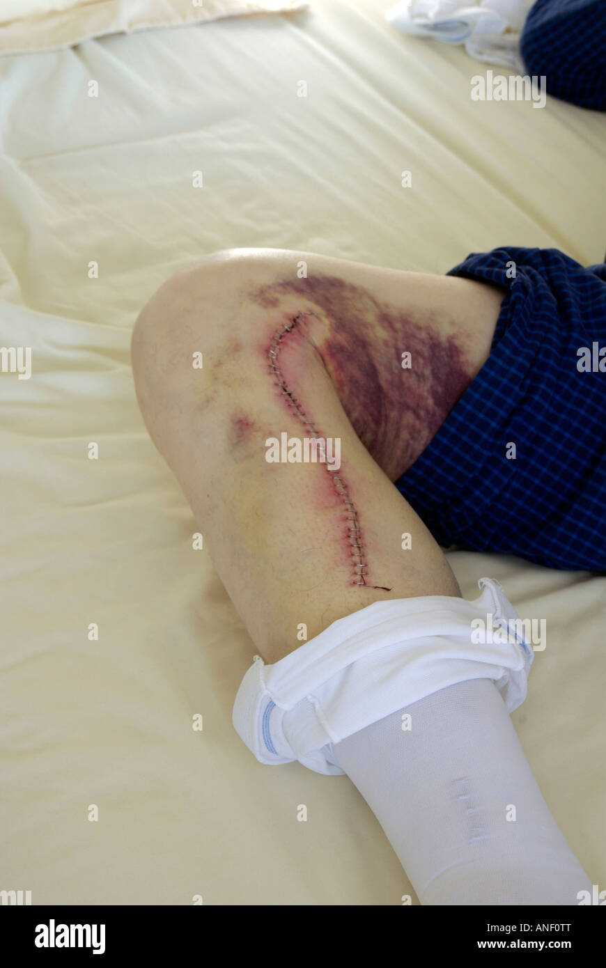 Staple stiches & bruises male leg after coronary artery bypass graft to borrow vein with anti blood clot surgical stocking rolled down Stock Photo
