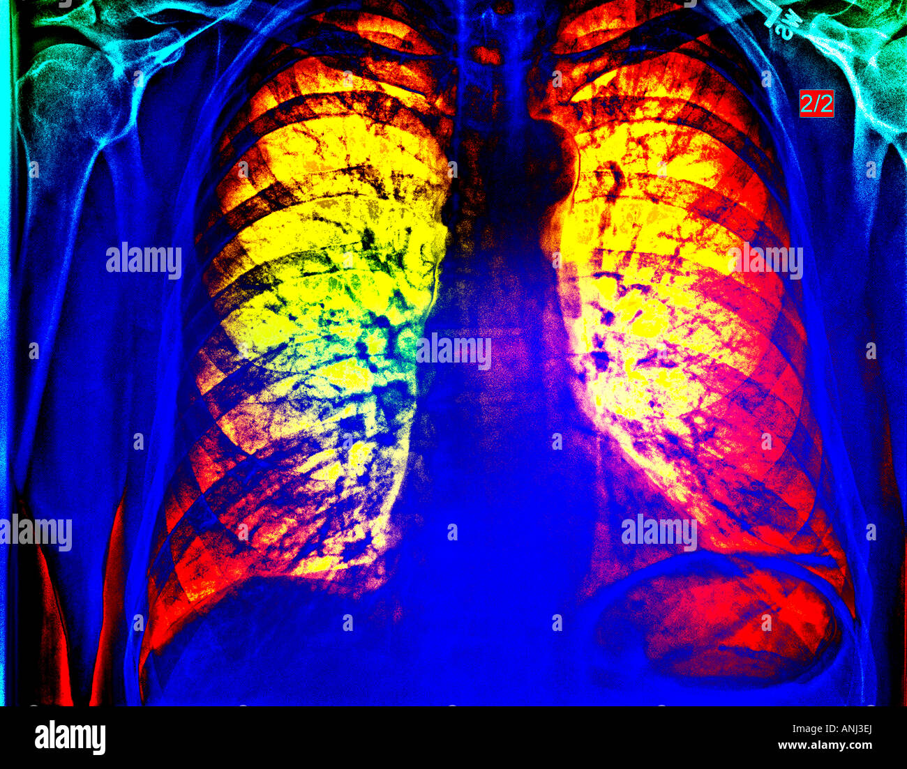colored coded chest xray Stock Photo Alamy