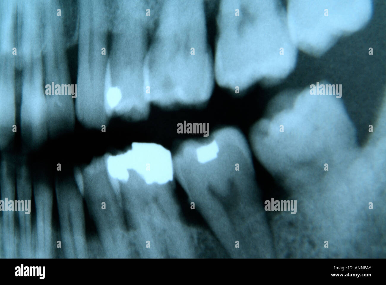 Dental Xray image showing dental amalgam Stock Photo Alamy
