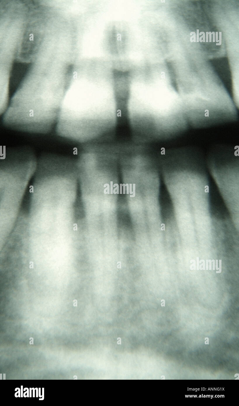 Dental x ray amalgam hires stock photography and images Alamy
