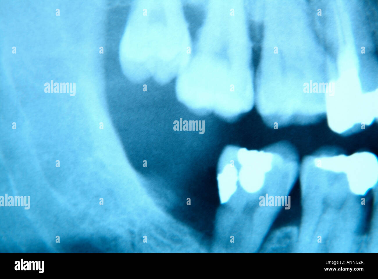 Dental x ray amalgam hires stock photography and images Alamy