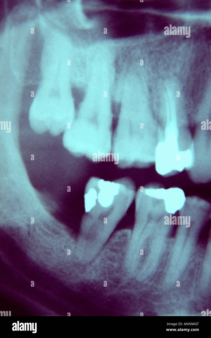 Dental Xray image showing dental amalgam Stock Photo Alamy