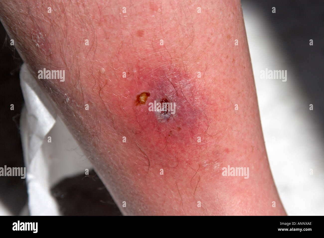 Septic leg wound and scab on shin of middle aged man Stock Photo - Alamy