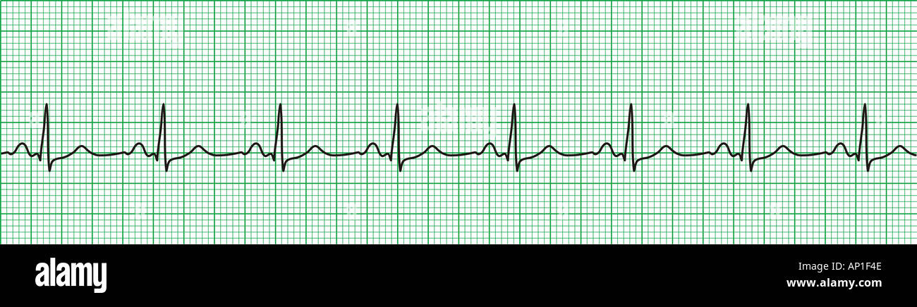 Normal ecg hi-res stock photography and images - Alamy