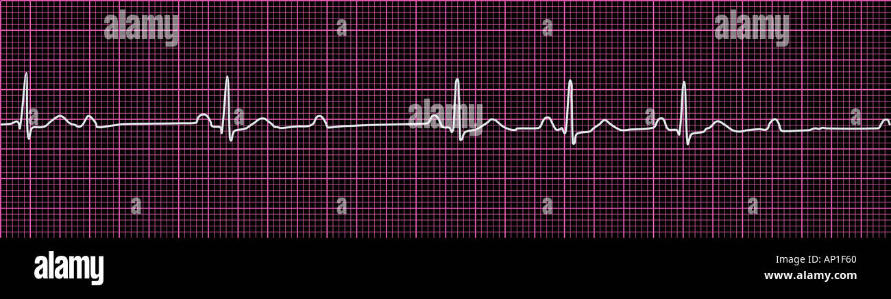 ECG electrocardiogram Stock Photo - Alamy