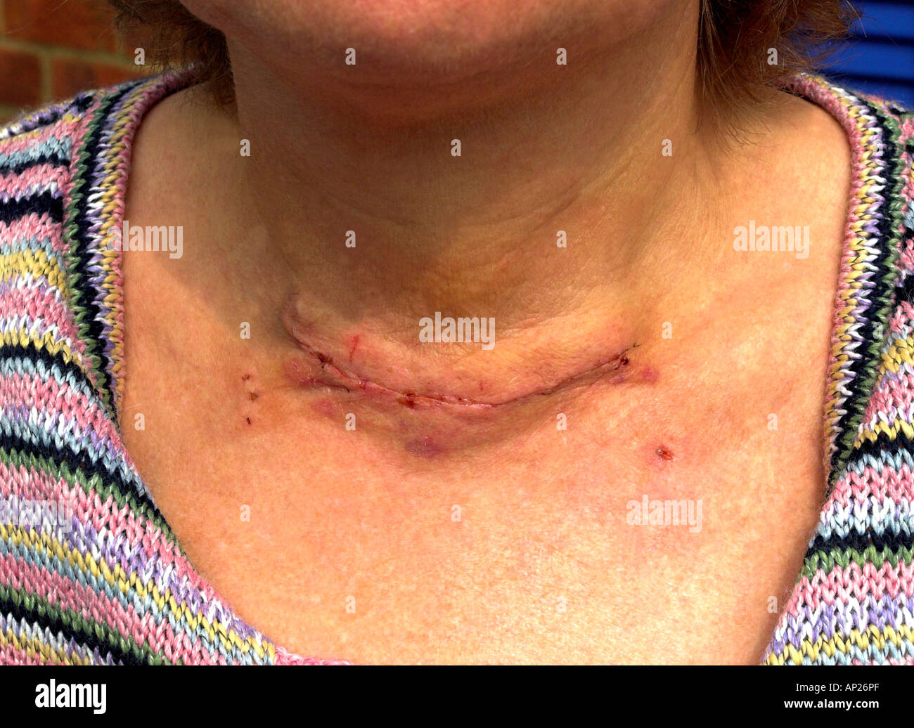 Post-operative scar following removal of a thyroid goitre Stock Photo