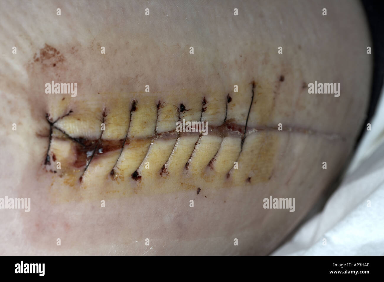 Sutures or stitches on a female thigh wound following a hip replacement Stock Photo