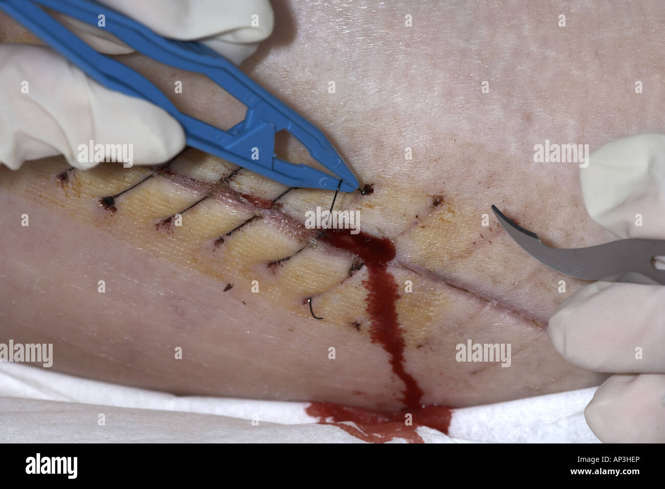 Surgical wound weeping as sutures or stitches are removed from a female thigh wound following a hip replacement Stock Photo
