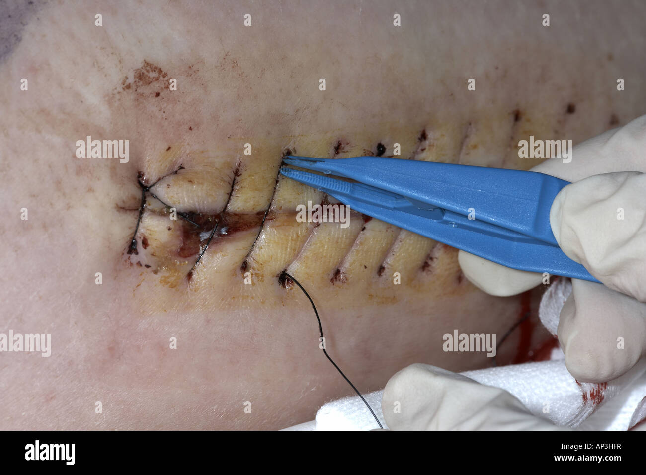 Removing sutures or stitches in a female thigh wound following a hip replacement Stock Photo