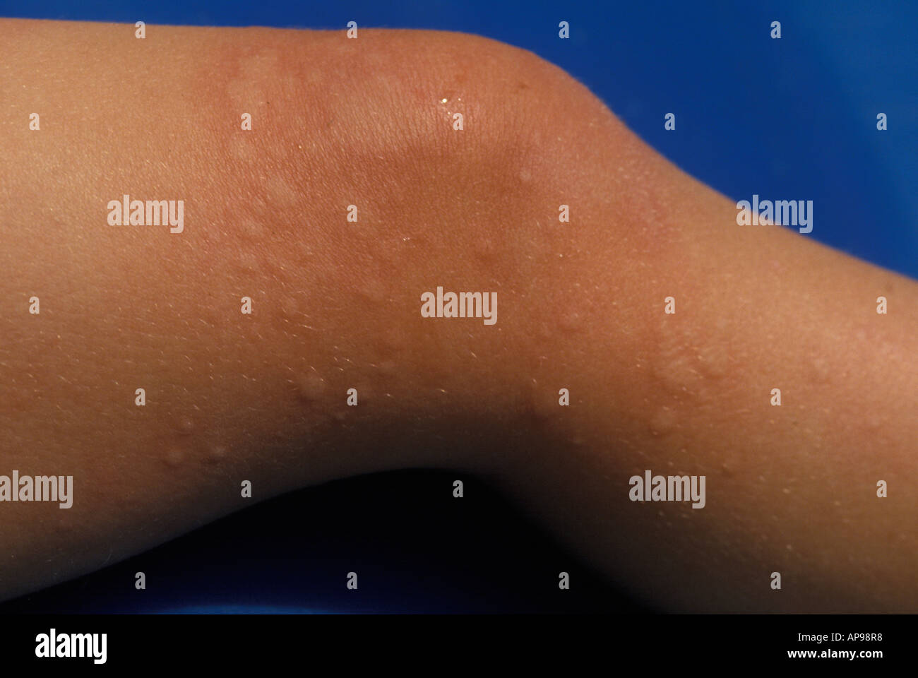 Nettle Rash Stock Photos & Nettle Rash Stock Images Alamy