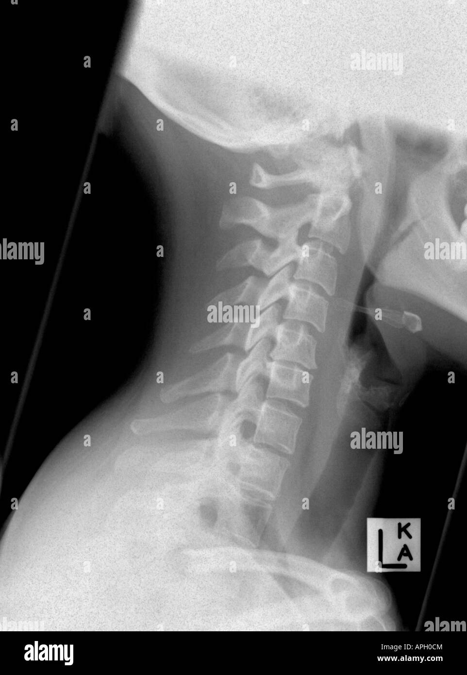 Lateral X-Ray of a cervical spine (neck), showing spasm, but no fracture, i.e. a sprain only Stock Photo