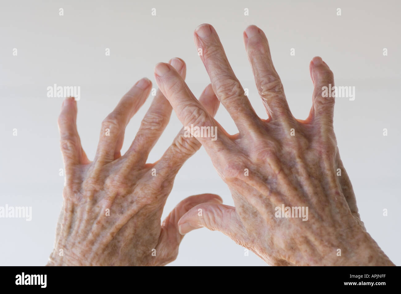 arthritic hands of an old woman Stock Photo Alamy