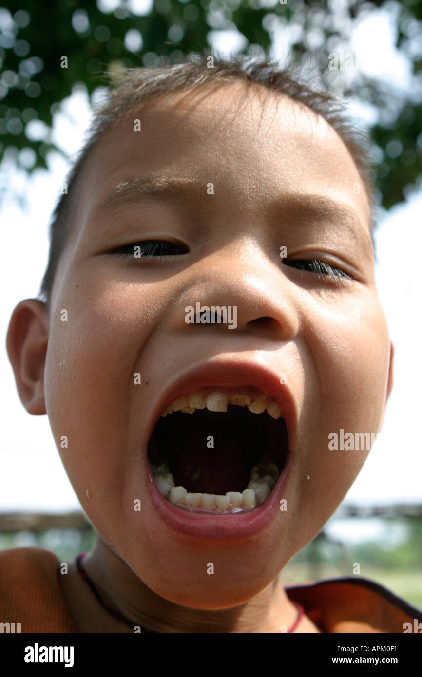young boy bad teeth mouth open Stock Photo - Alamy