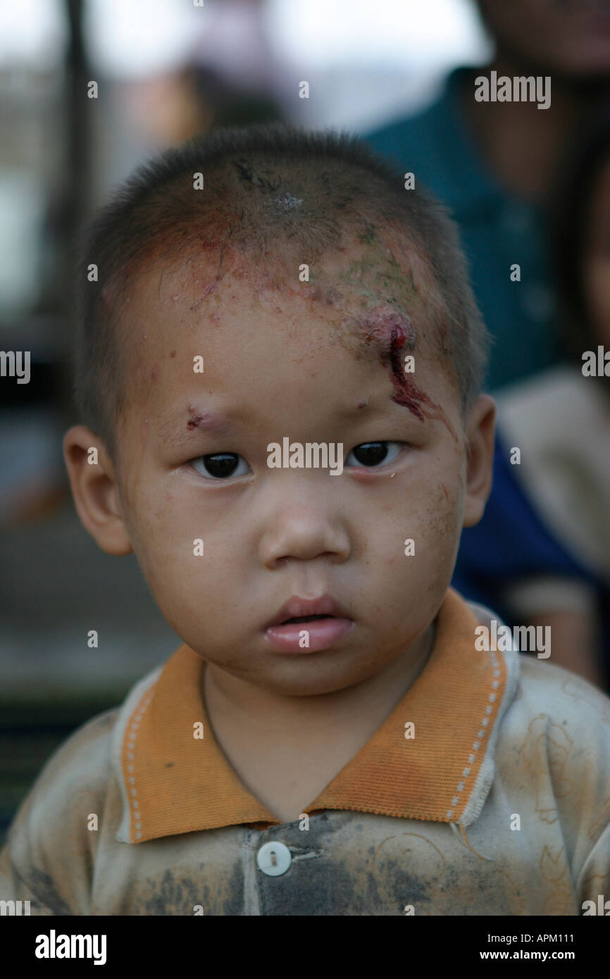 young boy with painful scar bruise bloody wound Stock Photo Alamy