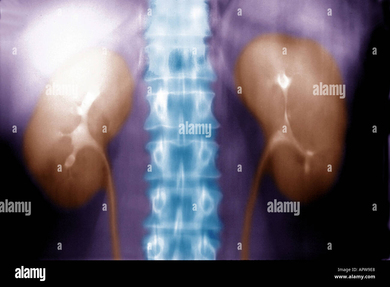 Intravenous pyelogram IVP of the kidneys showing how the intravenous dye shows the kidneys and