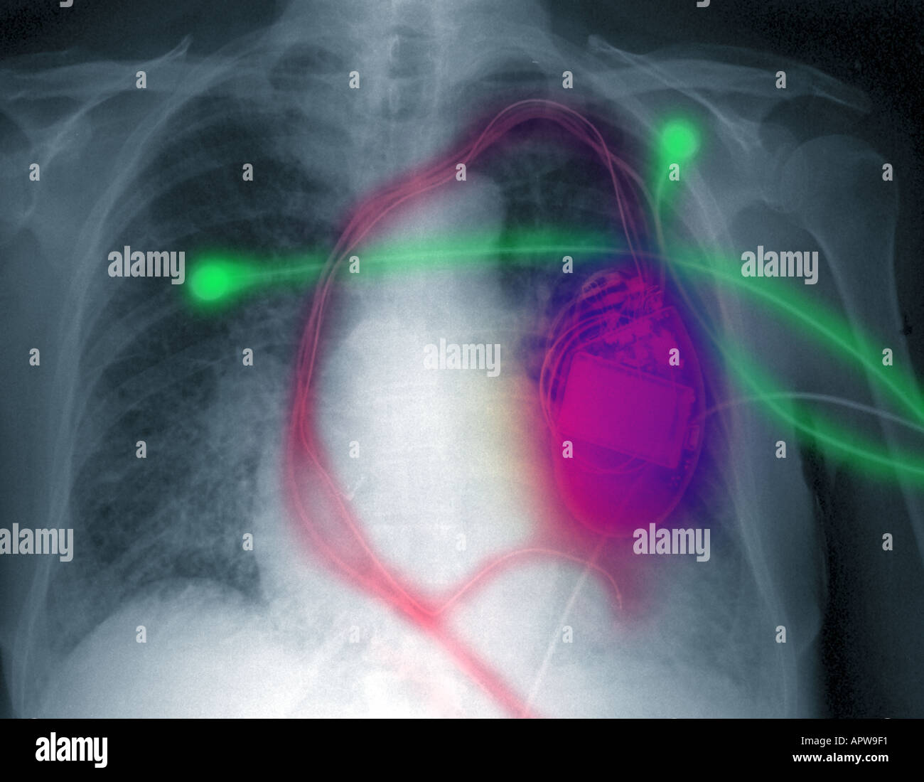 chest xray showing cardiac pacer defibrillator Stock Photo Alamy