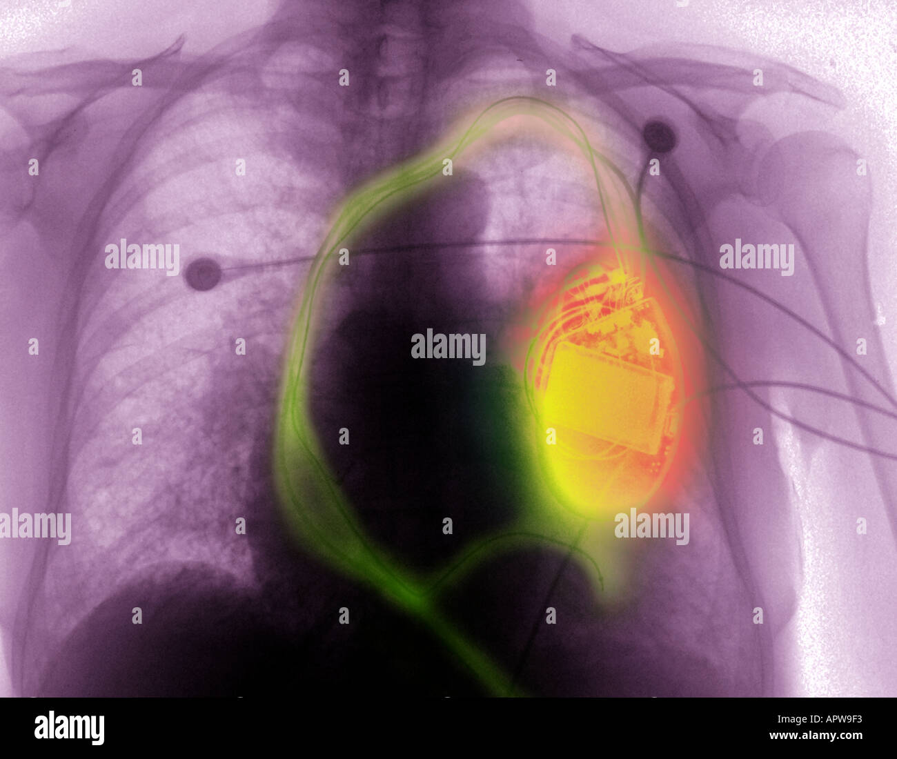chest xray showing cardiac pacer defibrillator Stock Photo Alamy