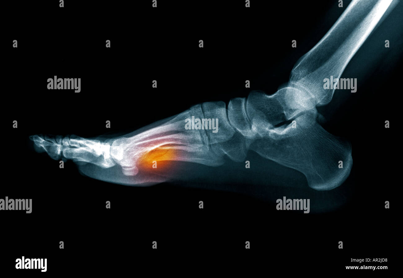 human foot xray Stock Photo - Alamy